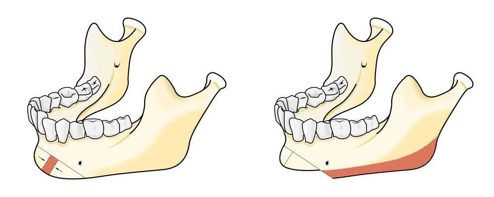 Figure 10. Sliding Genioplasty Middle Excise small.jpg
