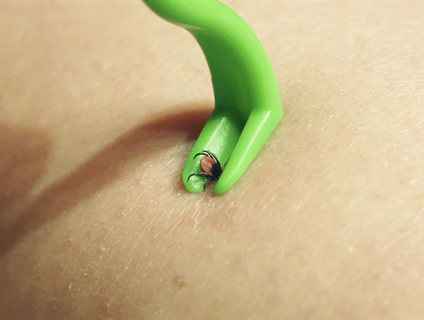 Tick-removal---close-up_pre.jpg