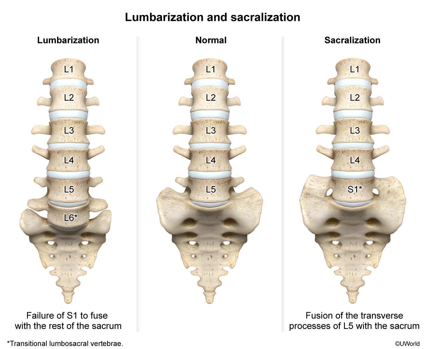 Lumbarization And Sacralization Cote Illustration lumbarization-and-sacralization-cote-illustration