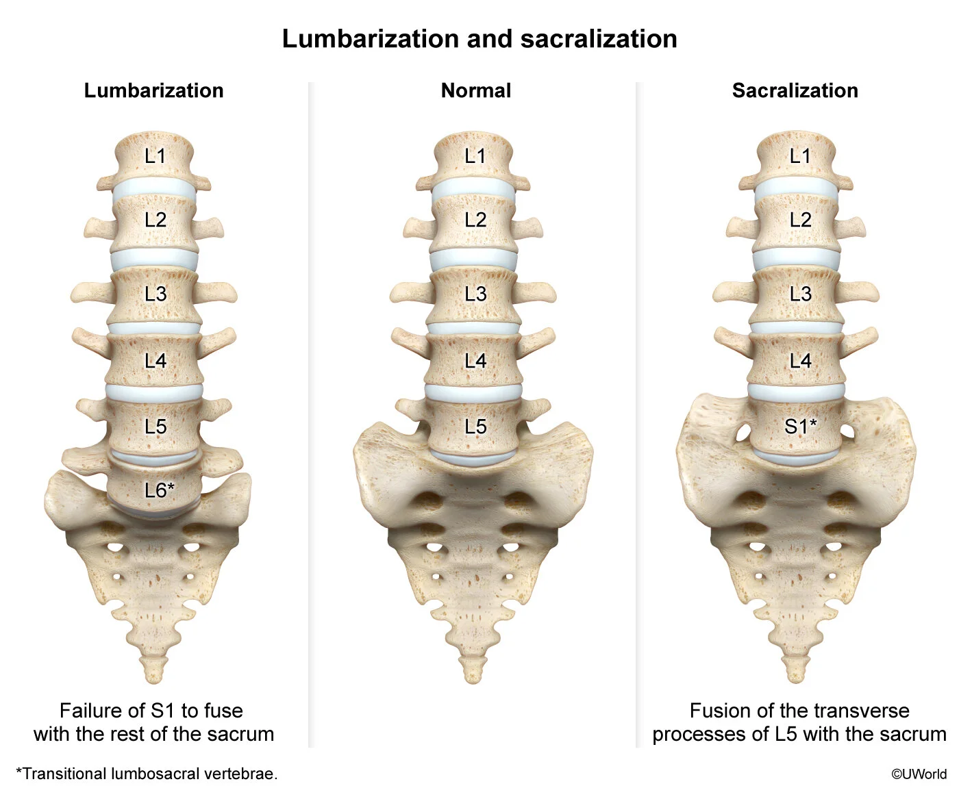Lumbarisation