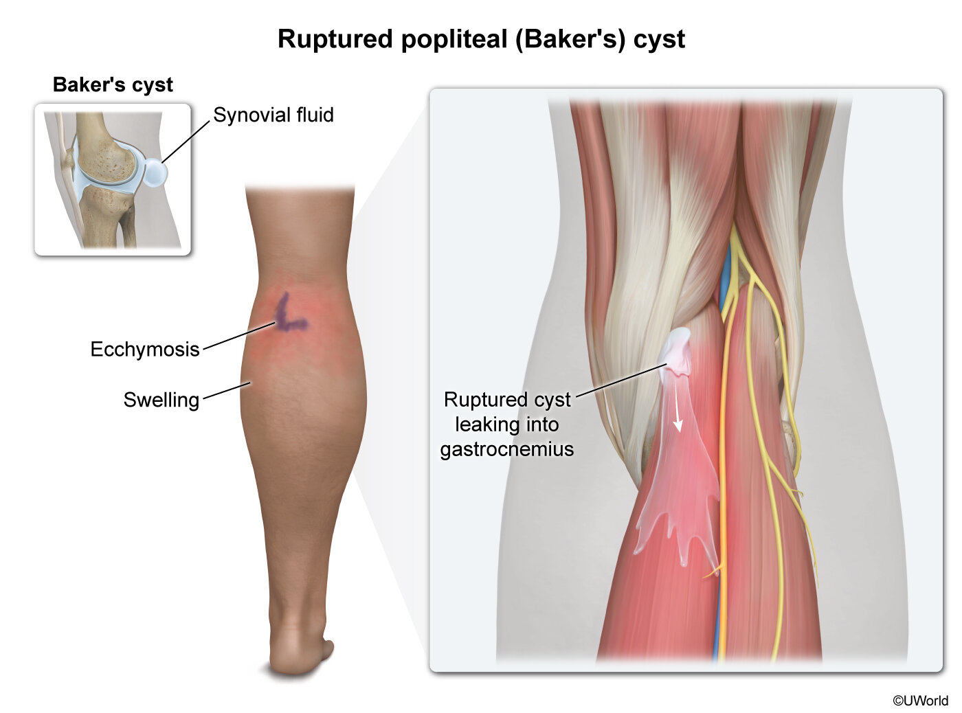 Ruptured Popliteal Baker s Cyst Cote Illustration ruptured-popliteal-baker-s-cyst-cote-illustration