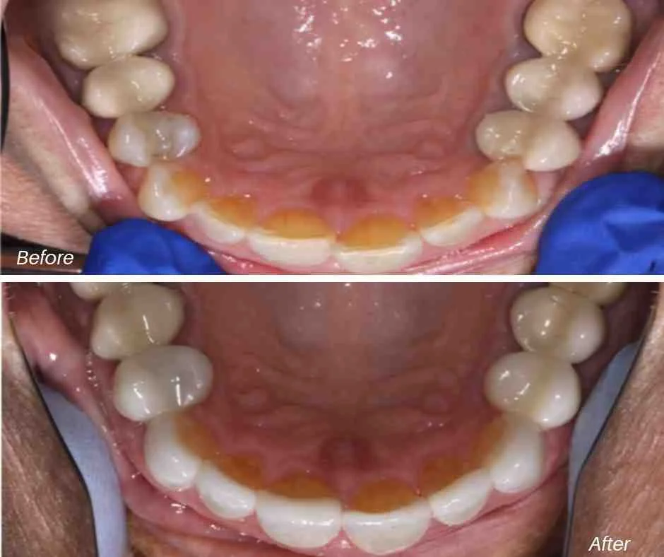 VENEER_BEFORE_AFTER_4_ELLIS_DENTAL.jpg