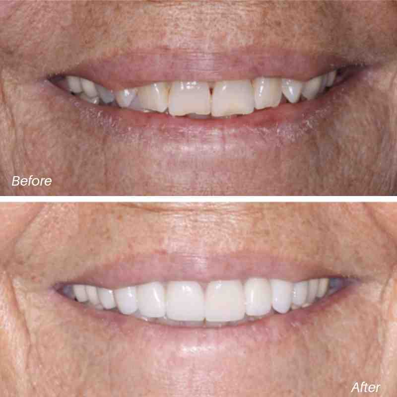 VENEER BEFORE AFTER ELLIS DENTAL.jpg