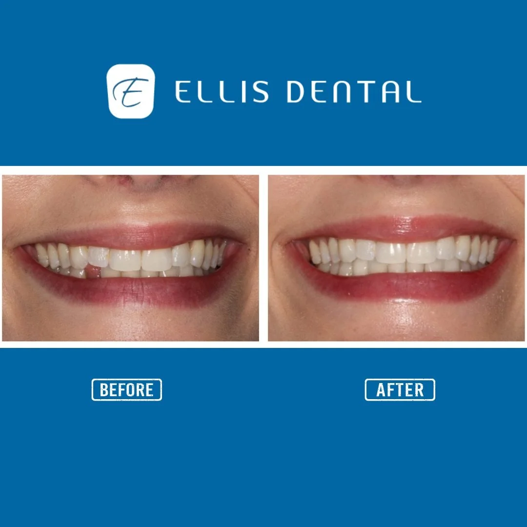 A young female patient came to us with a missing lower right canine tooth.

Dr. Ellis worked with her to restore her smile and function with a dental implant. If you only look at the photos on the right, you can&rsquo;t even tell which tooth was miss
