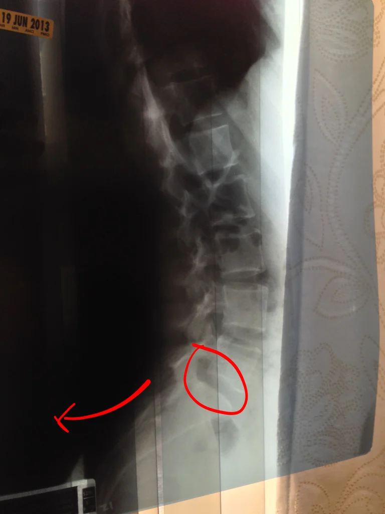 Sacrum tilted upward creates narrower intervertebral space at L5-S1