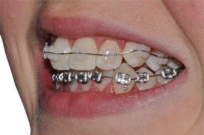 Braces on one of our patients in Lindfield