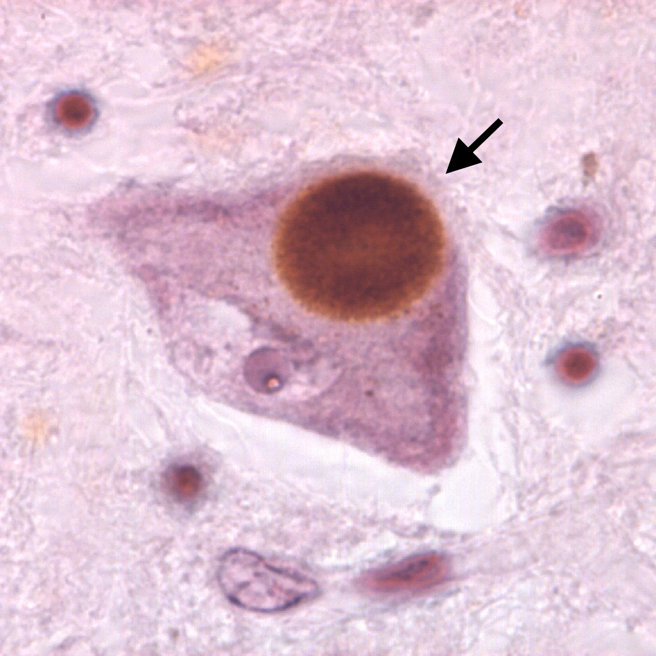 PLA2G6 Lewy body.jpg