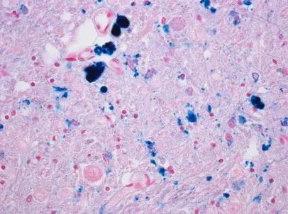     The Kotzbauer lab at Washington University School of Medicine works to advance understanding of neurodegenerative disorders and to translate this knowledge into new treatments.   Learn More  