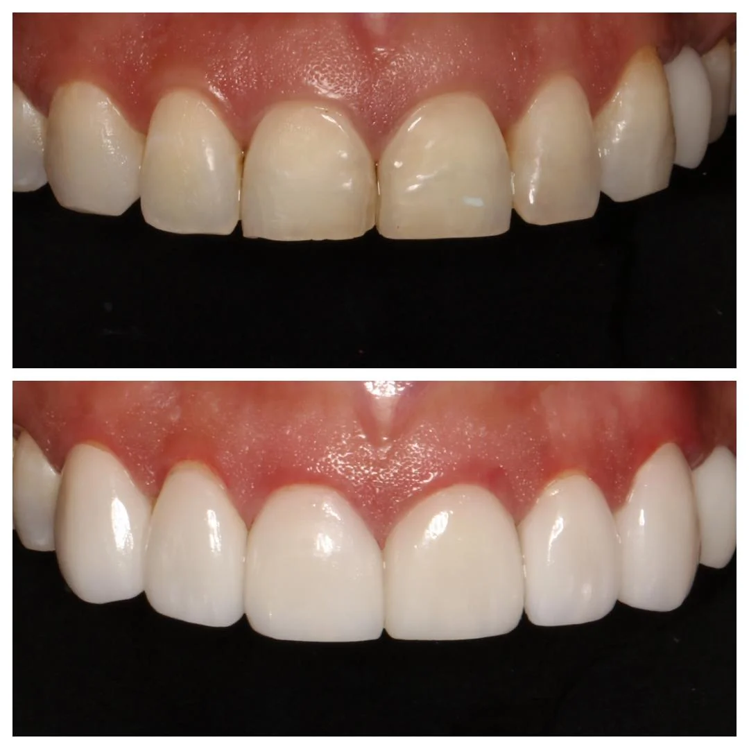 Veneers.jpg