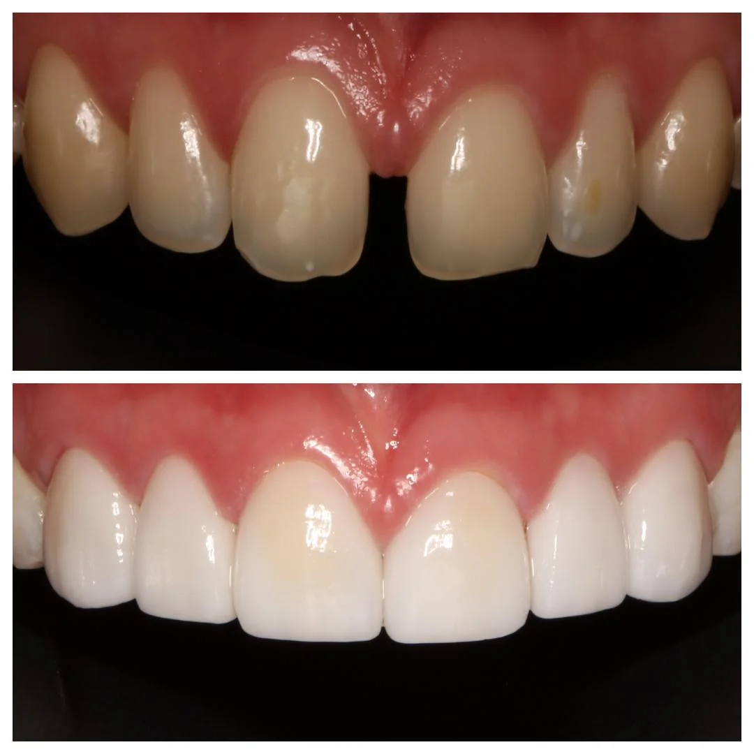 veneers3.jpg