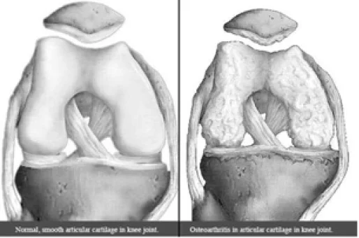 Normal and Osteoarthritic Joints (Source: Healthpages)