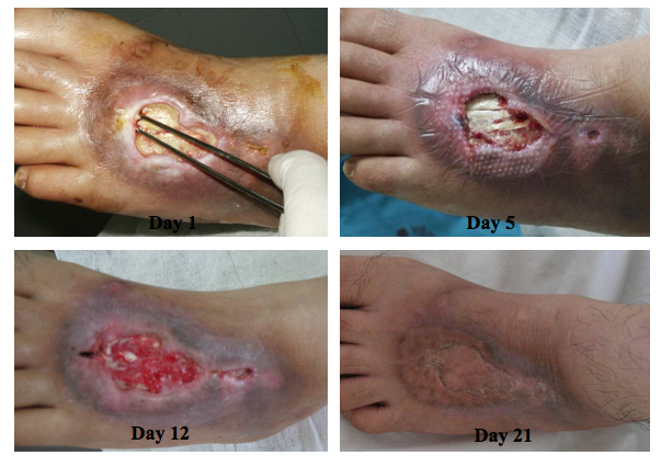 CLSC treatment to heal a full thickness chemical burn with exposed tendons