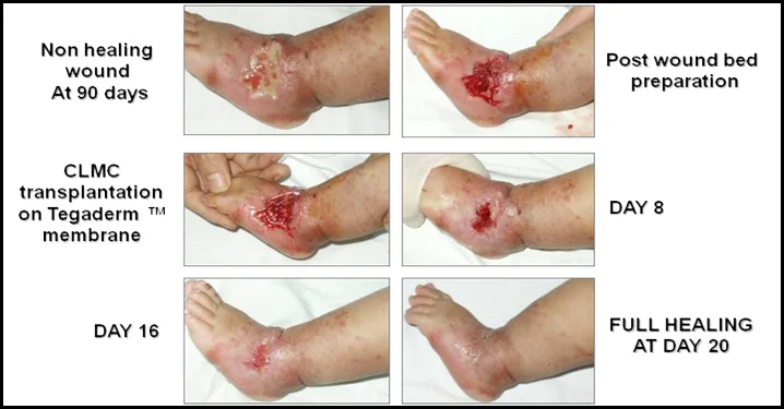 CLSC treatment and healing of a chronic ulcer from external irradiation