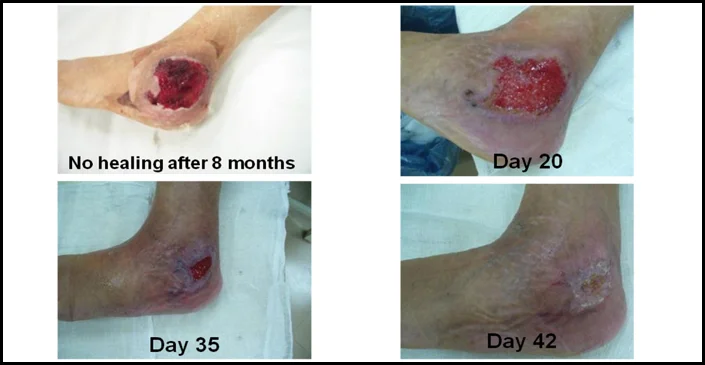 CLSC treatment and recovery of a chronic ulcer in a patient with Haemophilia A
