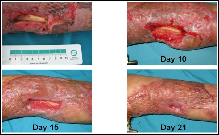 CLSC treatment and healing of a complex open forearm wound with exposed bone