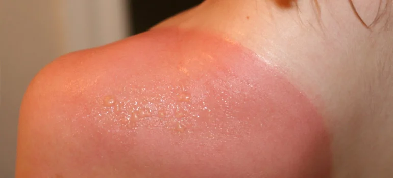Repeated sunburns in childhood increase the risk of skin cancer later on.