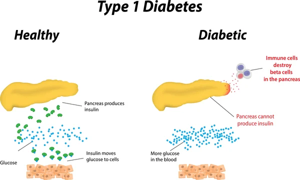 Diabetes Awareness Month - type-1-diabetes .jpg