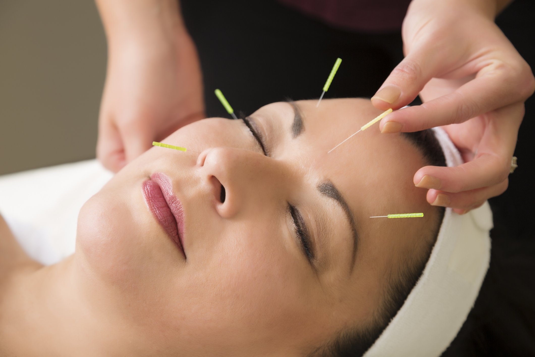 Woman receiving facial acupuncture with fine needles placed on her face