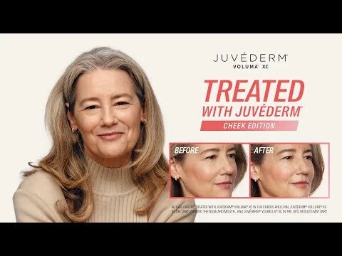 Add Volume for Lift in the Cheeks | The JUVÉDERM® Treatment Diaries