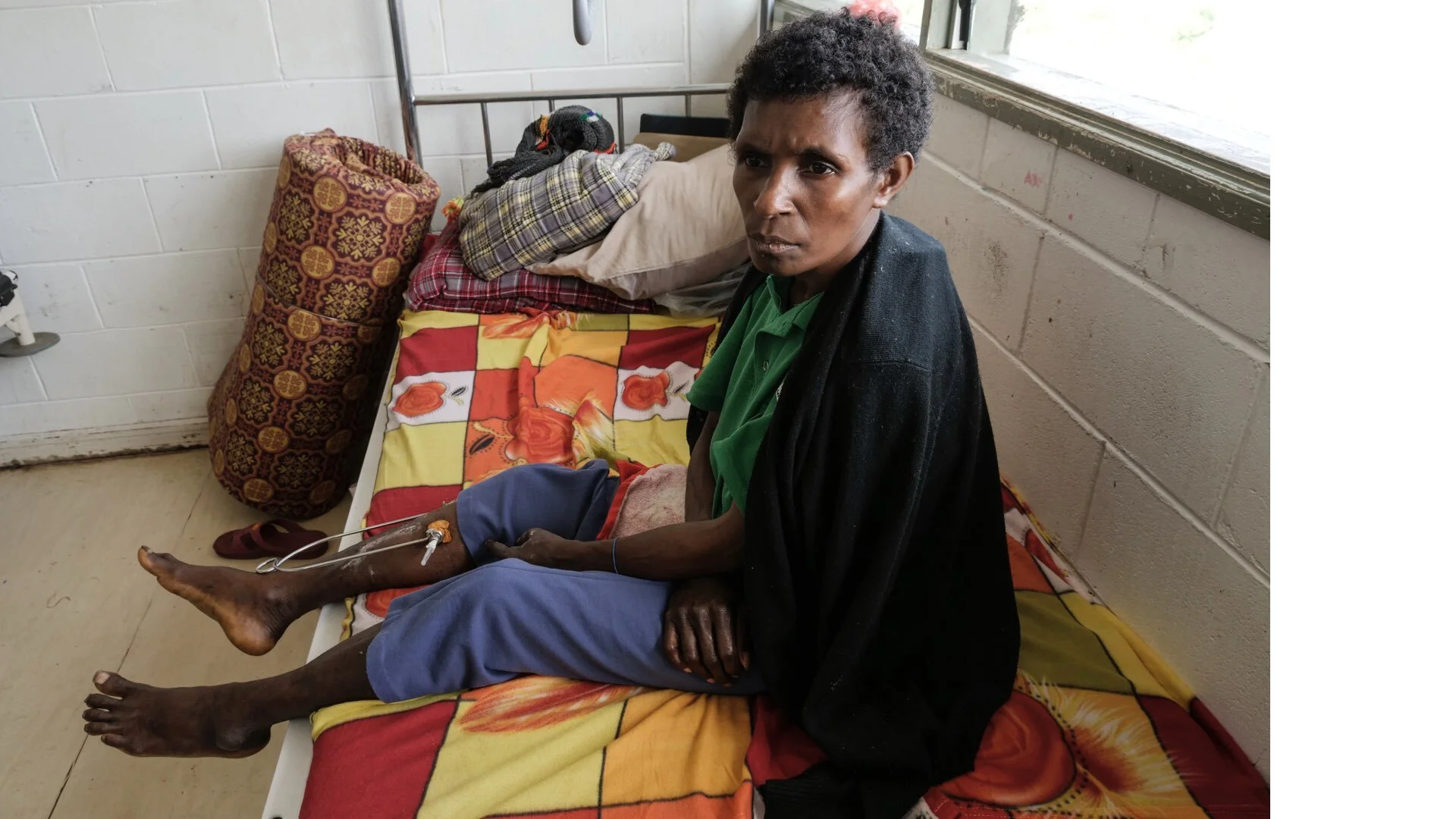 Papua New Guinea: Nangei Waiema sits on a hospital bed as she recovers from a fractured leg, an injury she sustained on 26 February 2018 after a landslide triggered by a 7.5 magnitude earthquake, at a hospital in Mount Hagen, Papua New Guinea, Monda…