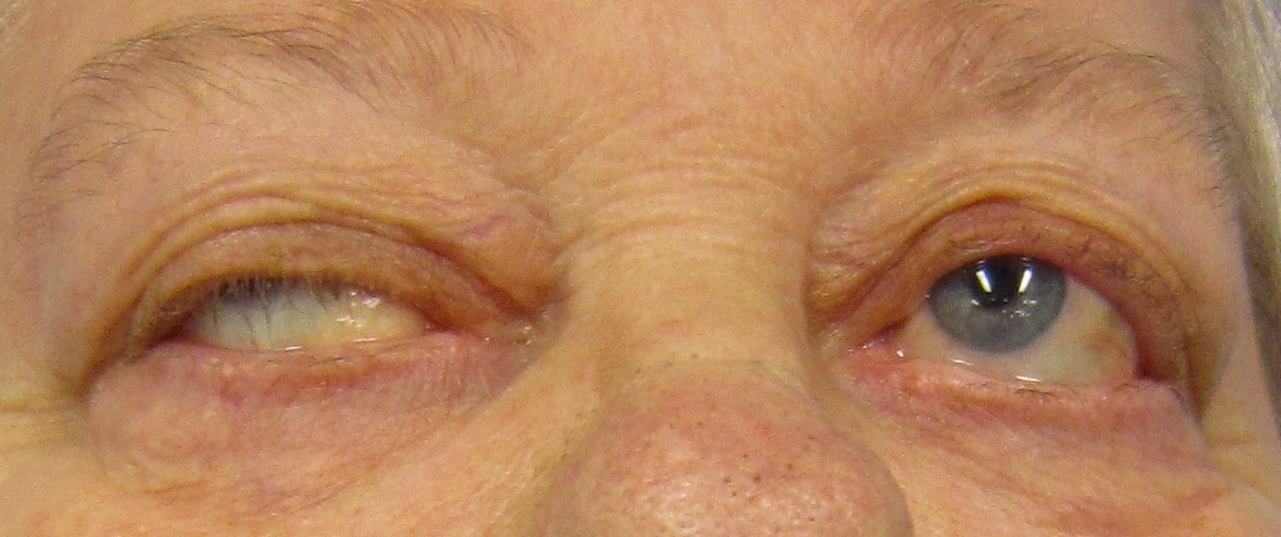 Eye deviation and a drooping eyelid in a person with myasthenia gravis trying to open their eyes