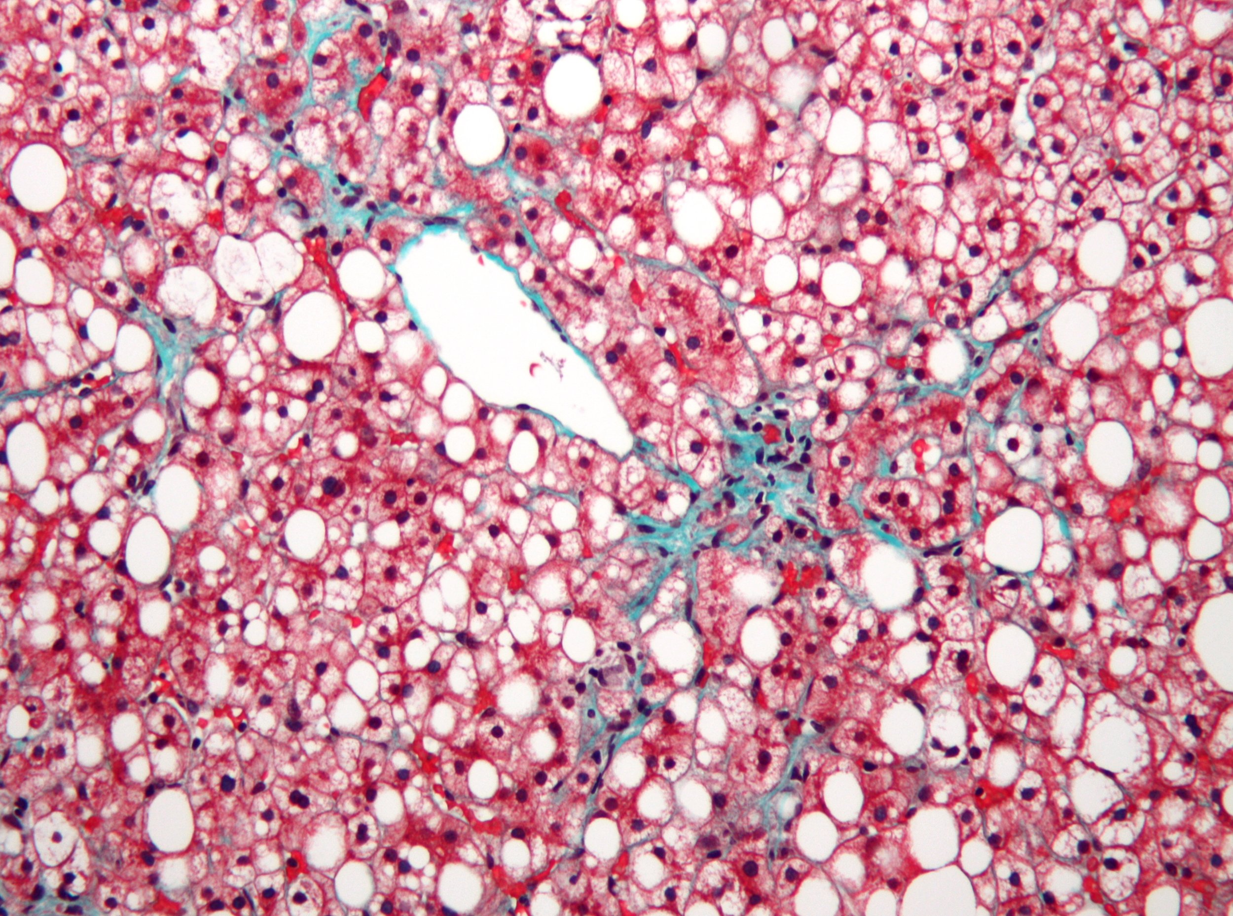 Micrograph of non-alcoholic fatty liver disease, demonstrating marked steatosis (fatty liver appears white).