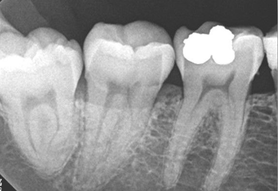 Pre treatment lower first molar.jpg