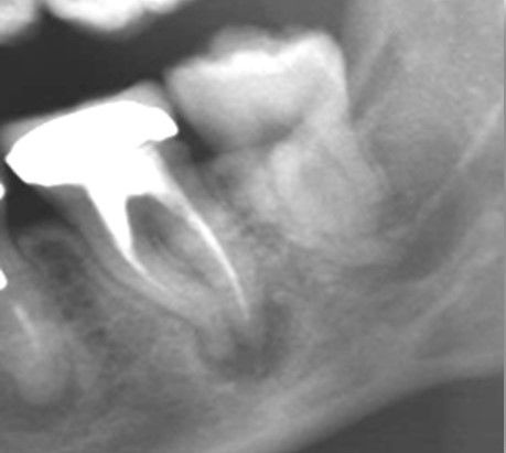 Pre re root canal treatment lower molar.jpg