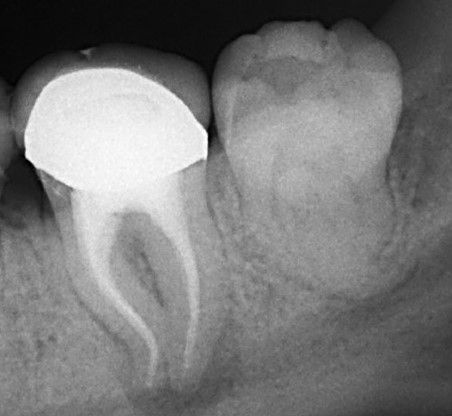 Post endodontic retreatment with S curved canal anatomy.jpg