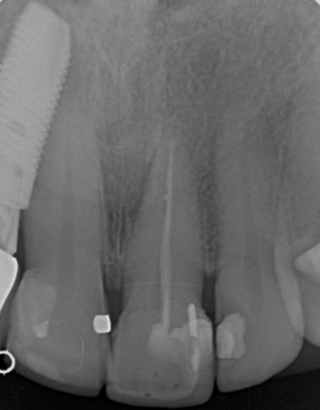 Upper central incisor re root canal treatment.jpg