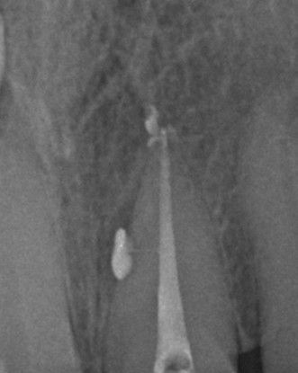 Post op upper central incisor showing lateral canal obturation.jpg
