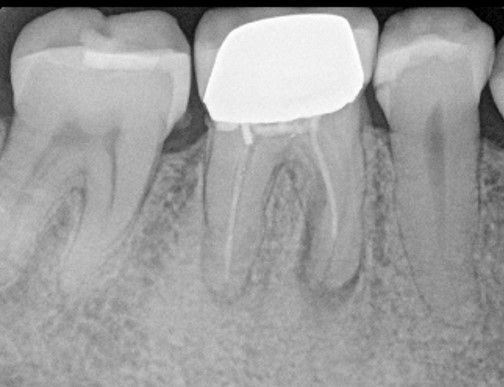 Lower molar re root canal treatment through crown.jpg