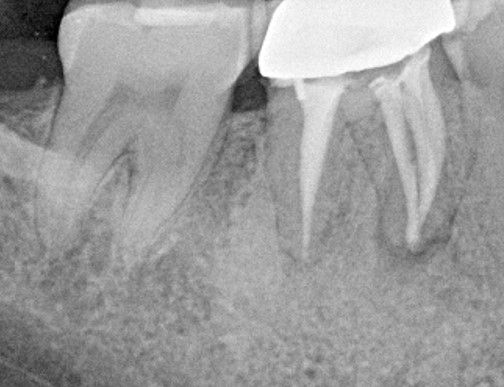 Lower molar re root canal with 3 mesial canals.jpg