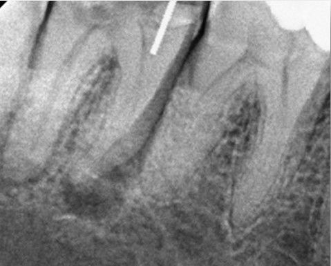 Pre endodontic treatment lower second molar tooth.jpg