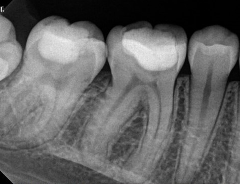 Before - Lower first molar