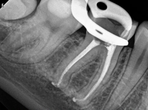 After - Lower first molar with apical curve