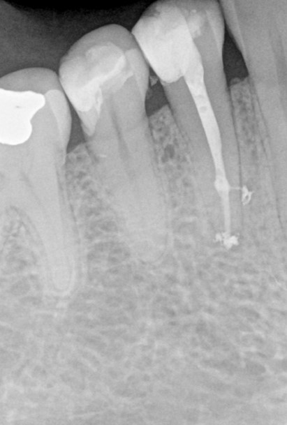 painless root canal treatment london