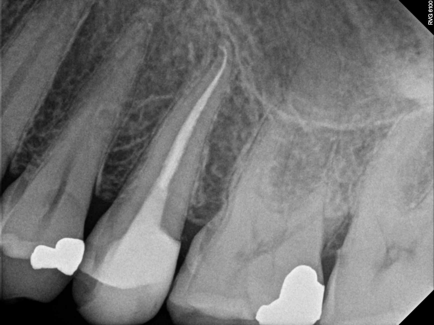 Curved root canal endodontist London