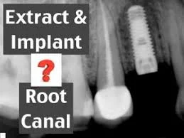 root -canal-vs-implant.jpg