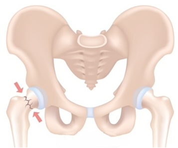 resized hip.png