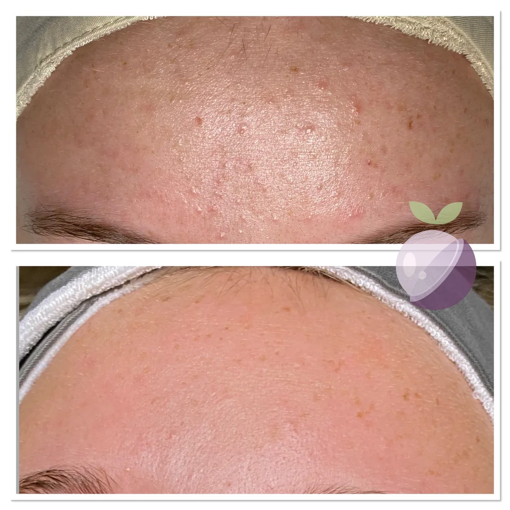 Apeeling Skin Acne Program With Face Reality And Infinity Skin Solutions Apeeling Skin In Parker Co