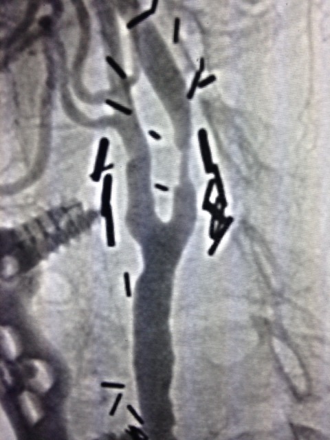 Angiogram of carotid stenosis