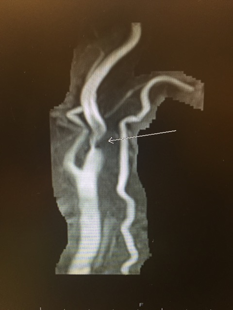 MRA of carotid stenosis