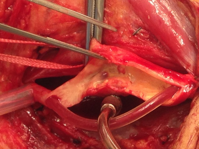 Intra-operative picture: plaque in carotid, note shunt carrying blood to brain