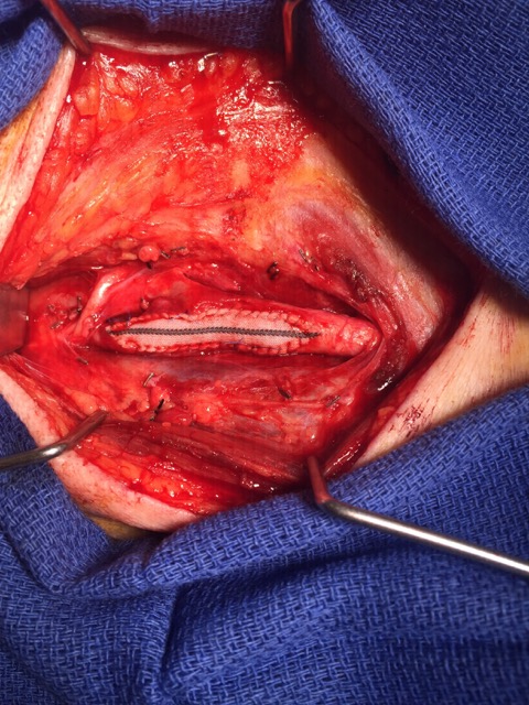 Carotid artery patched, open wider than ever