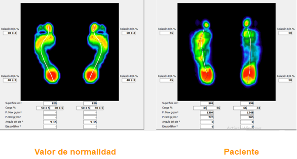Comparativa pie plano.png