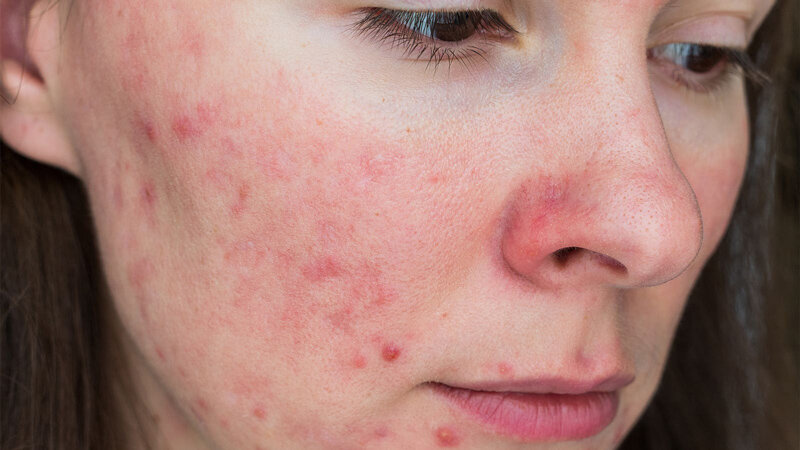 Acne Takes a Toll on Women's Mental Health, Quality of Life