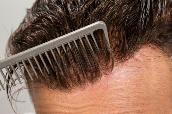 Young Men and Thinning Hair  