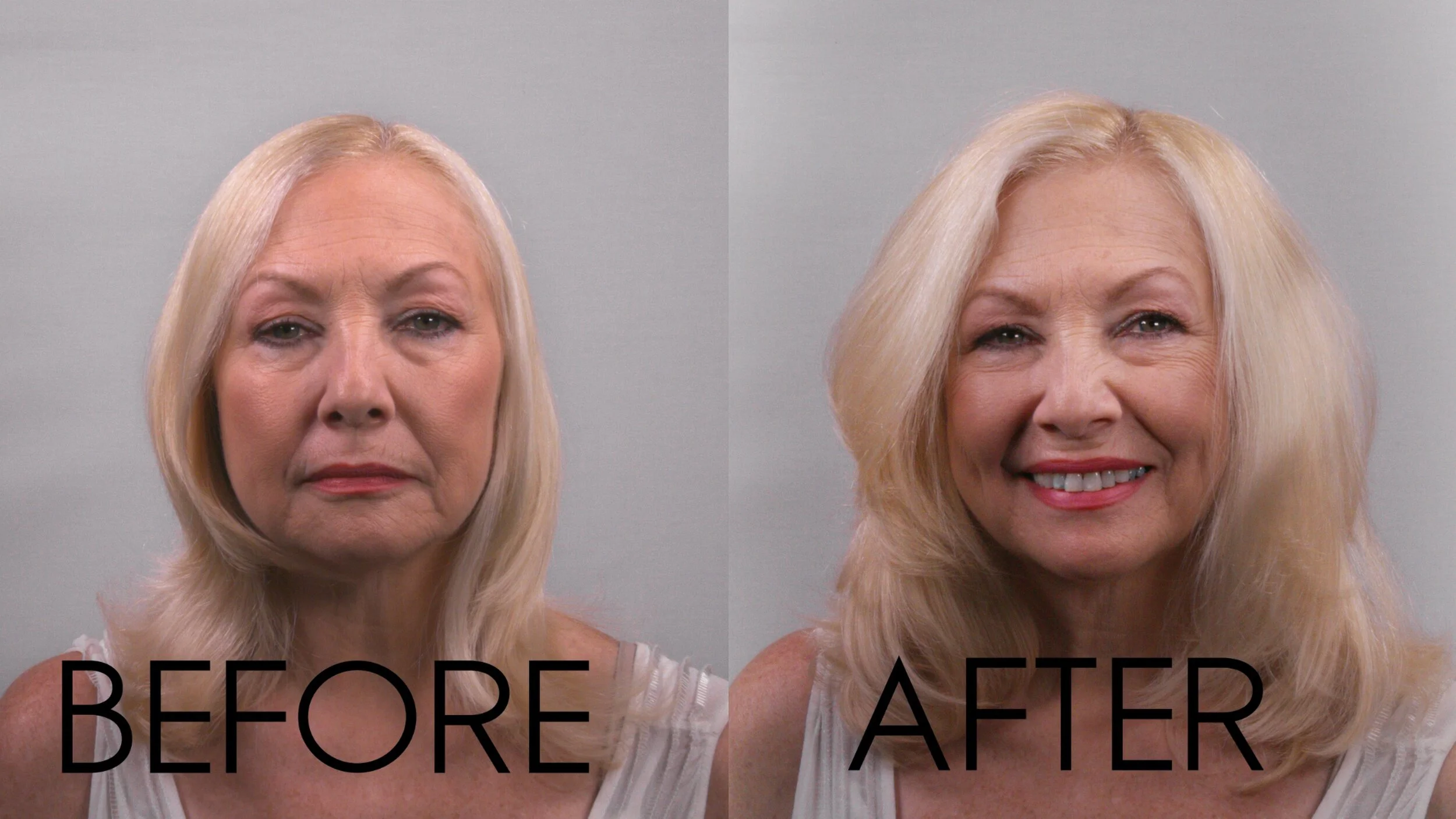Hair Loss During Menopause  