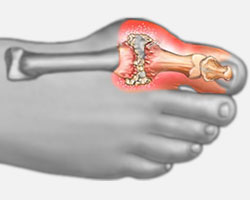 Arthritic Condition Care